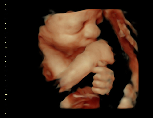 3D ultrasound image at 31 weeks